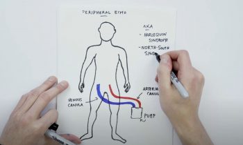 ECMO Differential Hypoxemia Explained